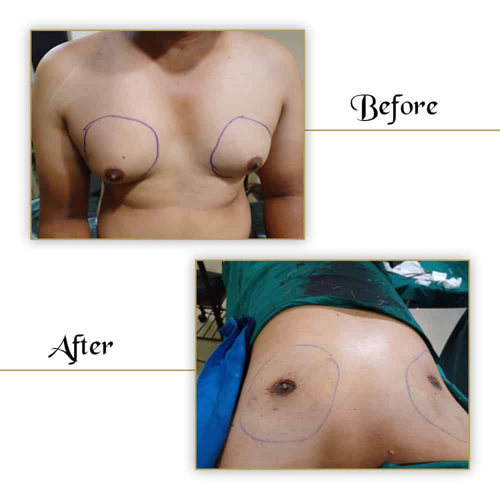 Breast augmentation before and after surgery at VJ Clinics, showing realistic results and surgical markings.