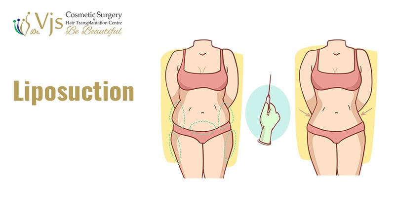 Liposuction procedure illustration showing before and after body contouring for fat reduction.