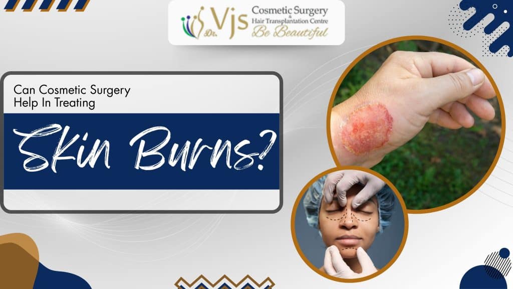 Can Cosmetic Surgery Help In Treating Skin Burns?